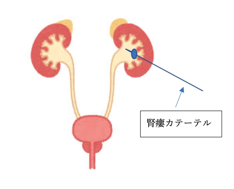 ②腎瘻造設方法について