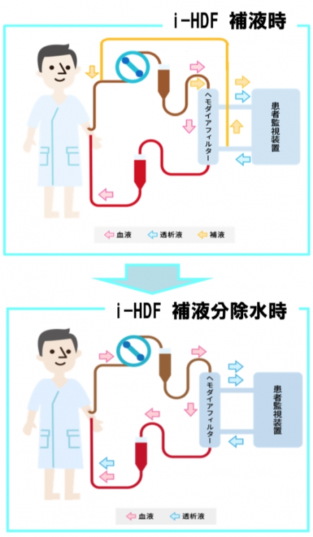 ② 間歇（かんけつ）補充型血液透析濾過 （i(ｱｲ)-HDF）